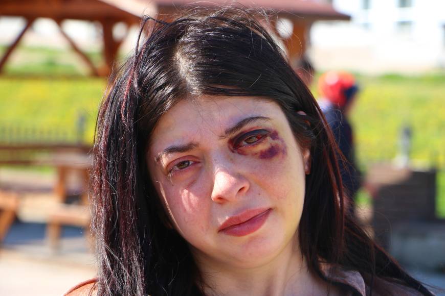 Sokak ortasında darbedilen Damla: 3 ay sıvı ile besleneceğim